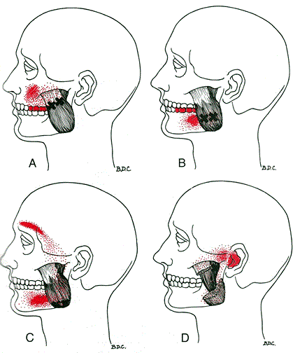 Masseter Triggerpunkt