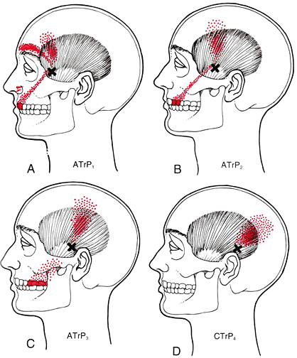 Temporalis Triggerpunkt