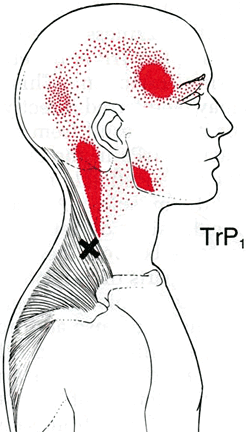 Trapezius Triggerpunkt